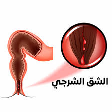 /شق شرجي